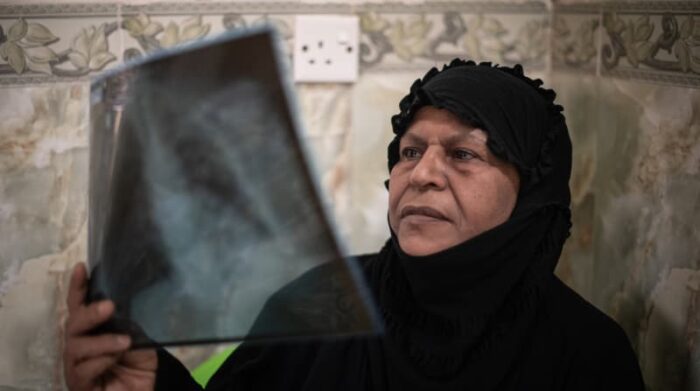 Bagdad, Irak, septiembre de 2021. Hameeda observa una radiografía de sus pulmones, luego de su exitoso tratamiento para la tuberculosis multirresistente con medicamentos orales más nuevos. Foto: Chloe Sharrock 