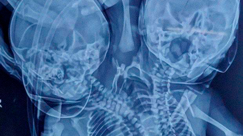 Radiografía del bebé que muestra sus dos cabezas y tres brazos unidos. Foto: redes sociales
