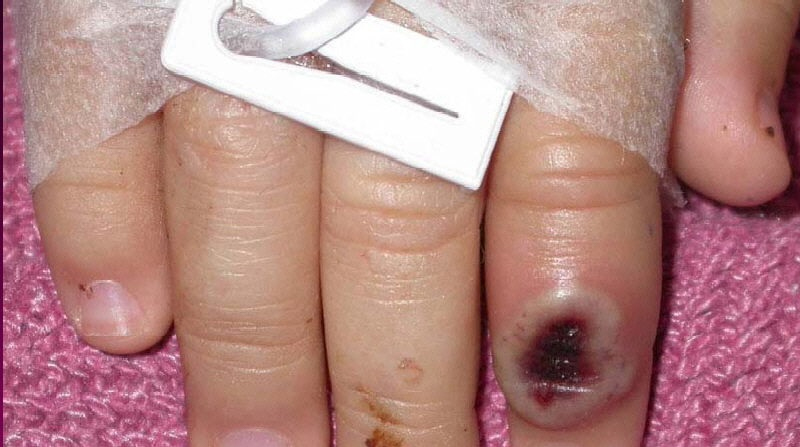 Fotografía del Centro Estadounidense de Control de las Enfermedades (CDC) en la que se aprecia el dedo de un niño infectado por la viruela de mono. Foto: EFE