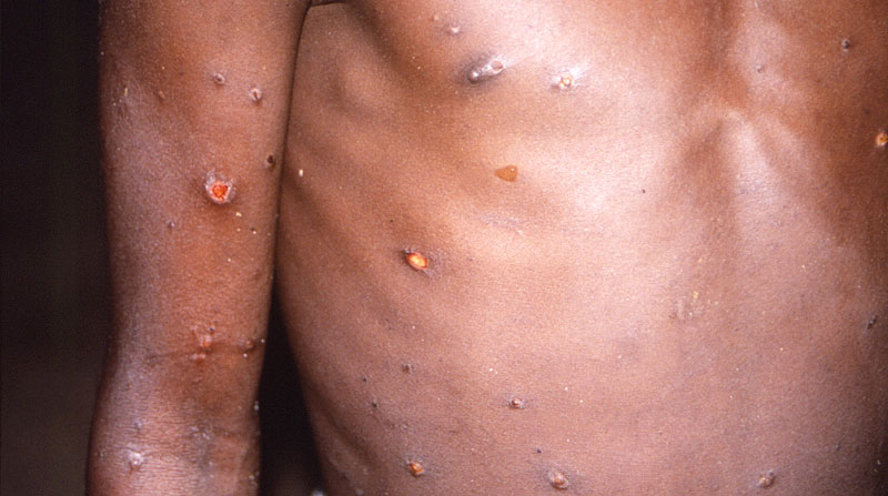 Imagen de las lesiones en la piel provocadas por la viruela del mono, durante un estudio llevado a cabo en la República Democrática del Congo entre los años 1996 y 1997. Foto: EFE