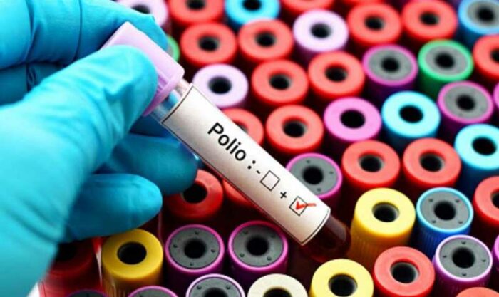 Imagen referencial. La polio es una enfermedad altamente contagiosa ocasionada por el virus de la poliomielitis. Foto: Pixabay