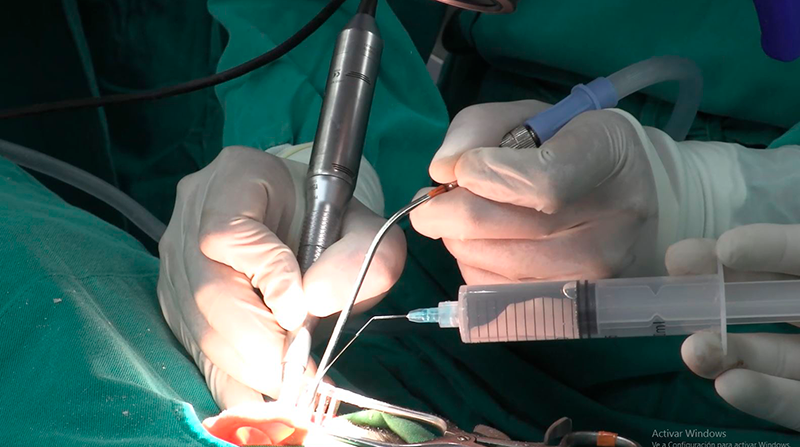 Las cirugías de implantes cocleares se realizan hace 17 años en el Hospital Carlos Andrade Marín. Foto cortesía HCAM