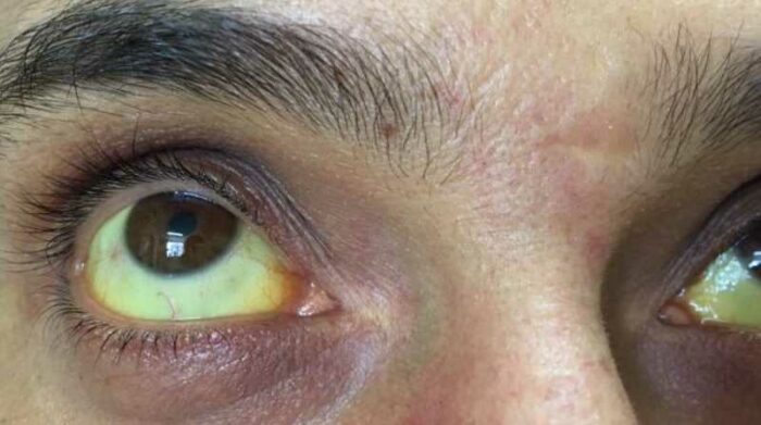 Uno de los síntomas de leptoptirosis es la coloración amarillenta en ojos y piel. Foto: Cortesía