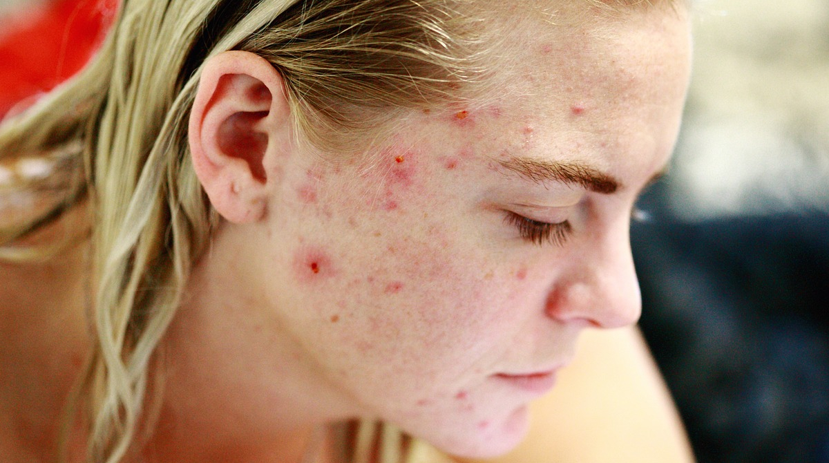 Mujer sufre de brotes de acné en su rostro. Foto: Pixabay