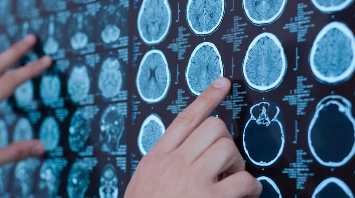 Un nuevo estudio científico trata de erradicar un tumor cerebral letal en humanos. Foto: Cortesía Twitter