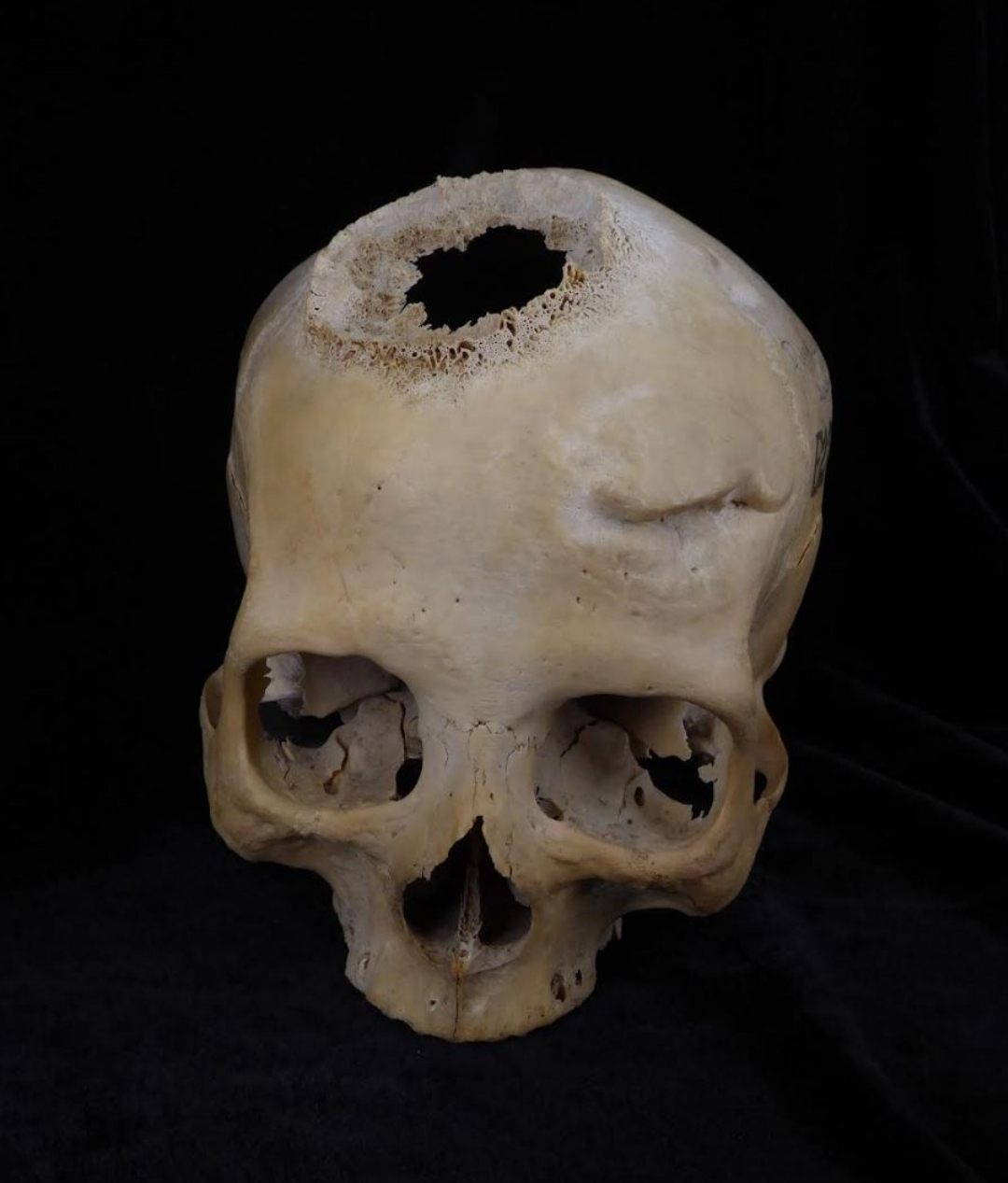 En la parte de arriba del cráneo se aprecia el agujero causado por la neoplasia. Foto: EFE